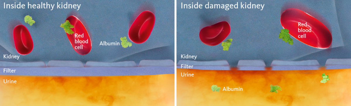 Vue schématique et simplifiée d'une membrane rénale saine et d'une membrane rénale endommagée, cette dernière illustrant la cause de l'albuminurie