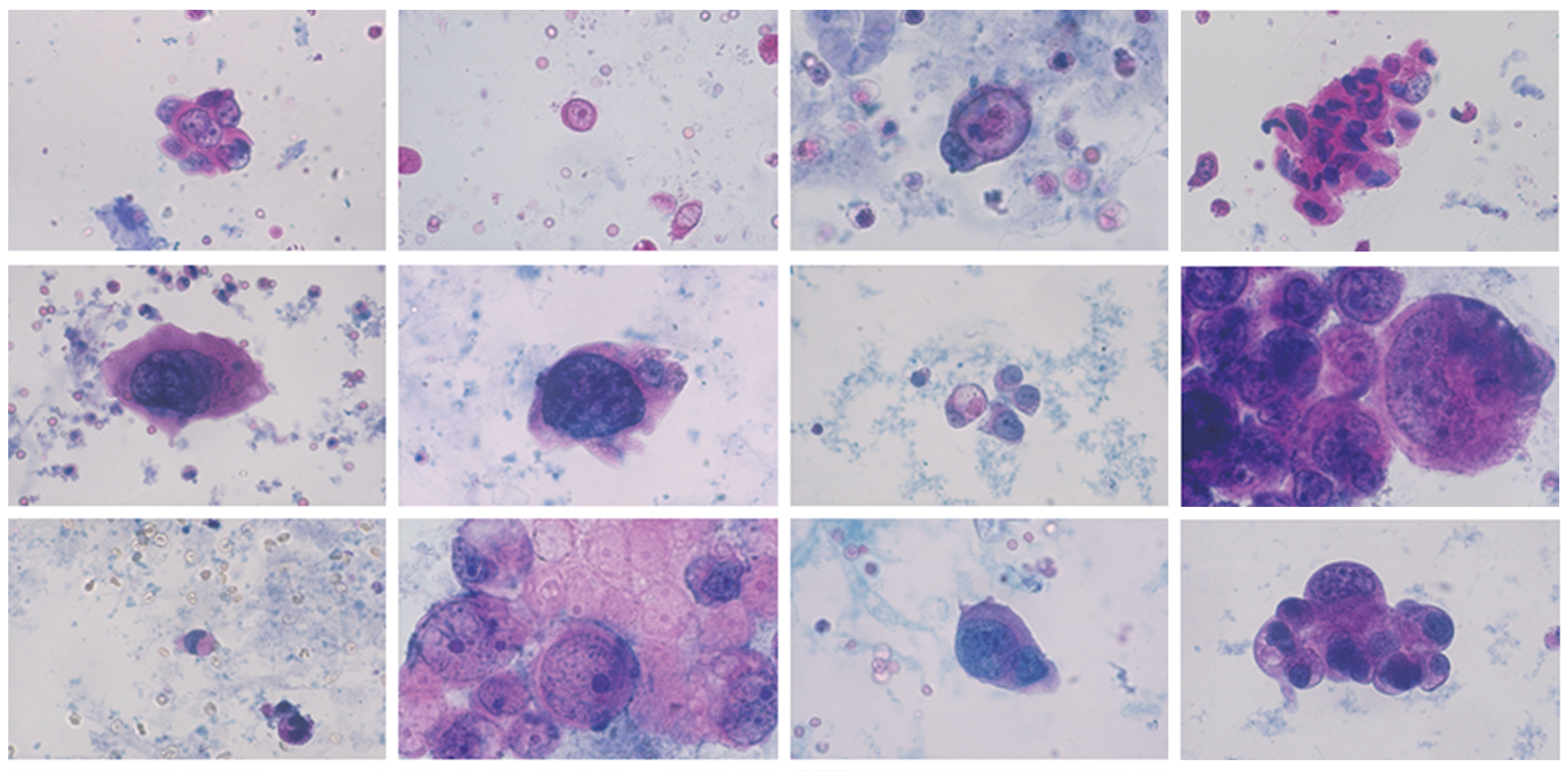 Diagnostic et surveillance du cancer de la vessie