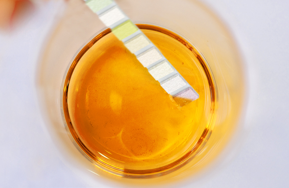 IU Diagnostic The first step in diagnosing a UTI is typically a simple urinalysis test, done using a urine sample. I