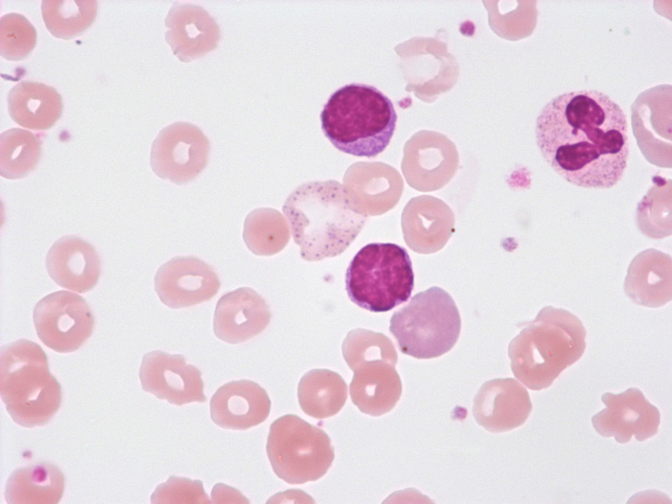 Globule rouge avec ponctuation basophile et polychromatophilie