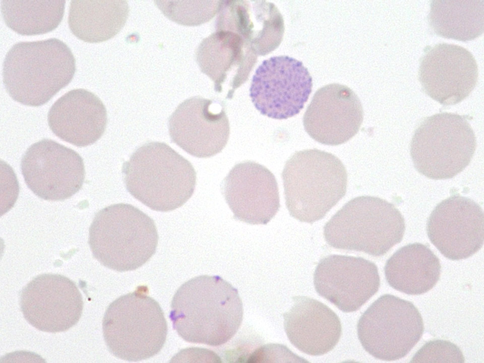 Hématie avec hémoglobine de type H Hématie avec hémoglobine de type H