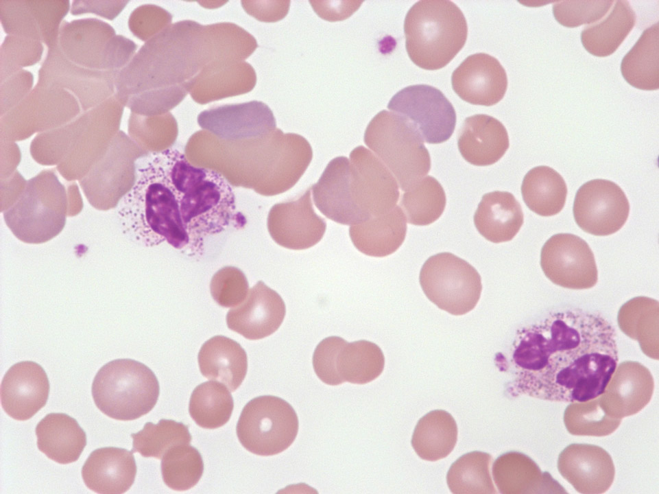 Hématies en rouleaux et agglutination Hématies en rouleaux et agglutination