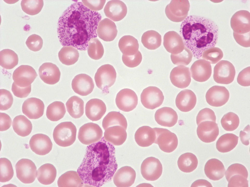 Granulocytes d'un patient traité par GCS- F