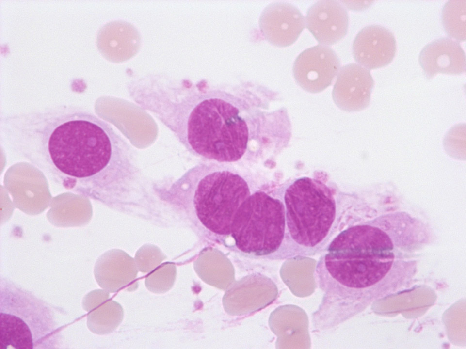 Cellules endothéliales sur frottis sanguin