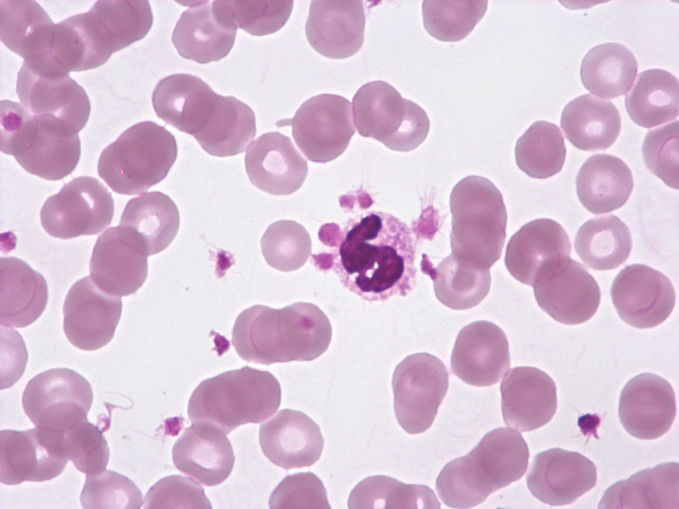 Accumulation de plaquettes sur les granulocytes