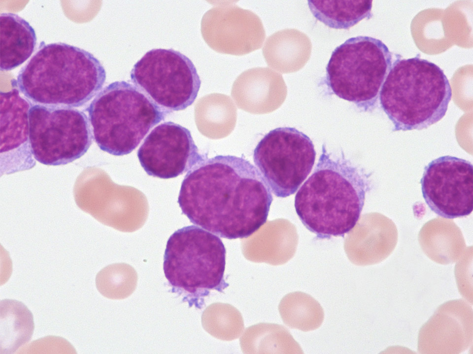 Leucémie à tricholeucocytes variante