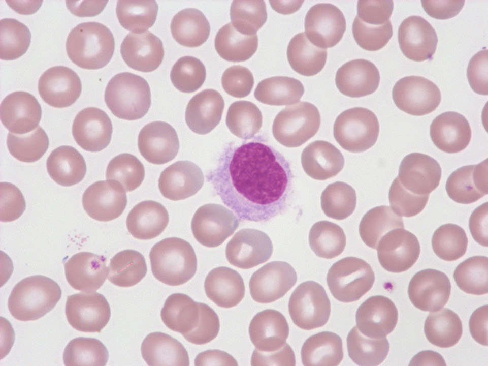 Leucémie à tricholeucocytes