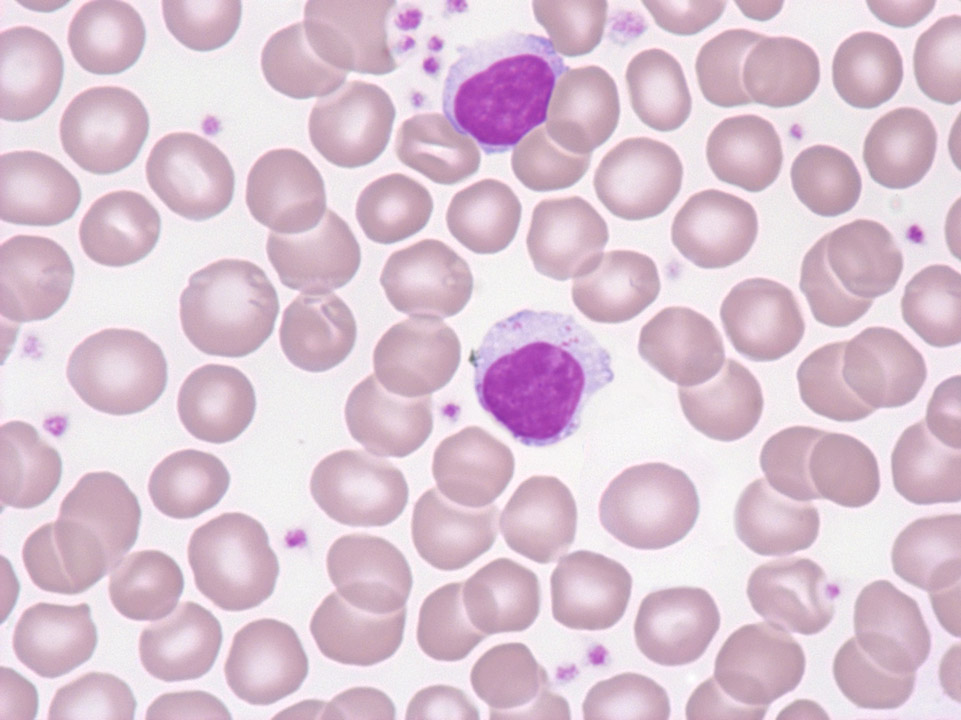 Leucémie à grands lymphocytes granuleux T (LGL)