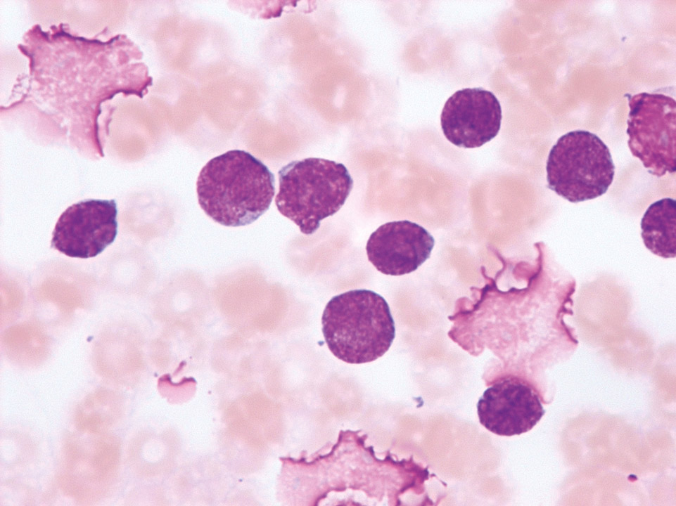 Leucémie aiguë lymphoblastique T ( LAL-T )