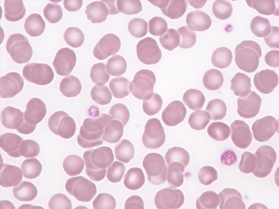 Thrombopénie et anisocytose plaquettaire