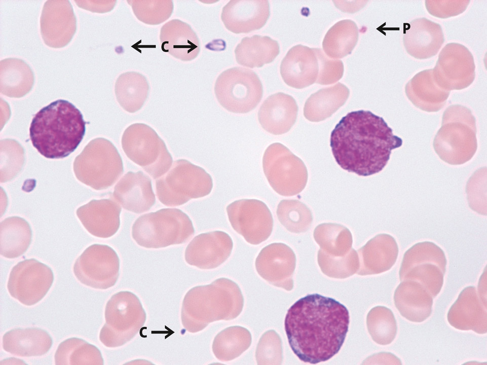 Thrombocytopénie et détection de fragments de cytoplasme de monoblastes