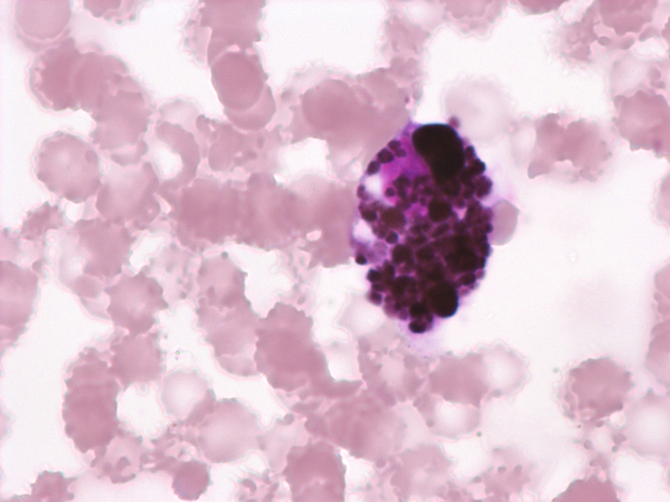 Cellules tumorales de mélanome malin