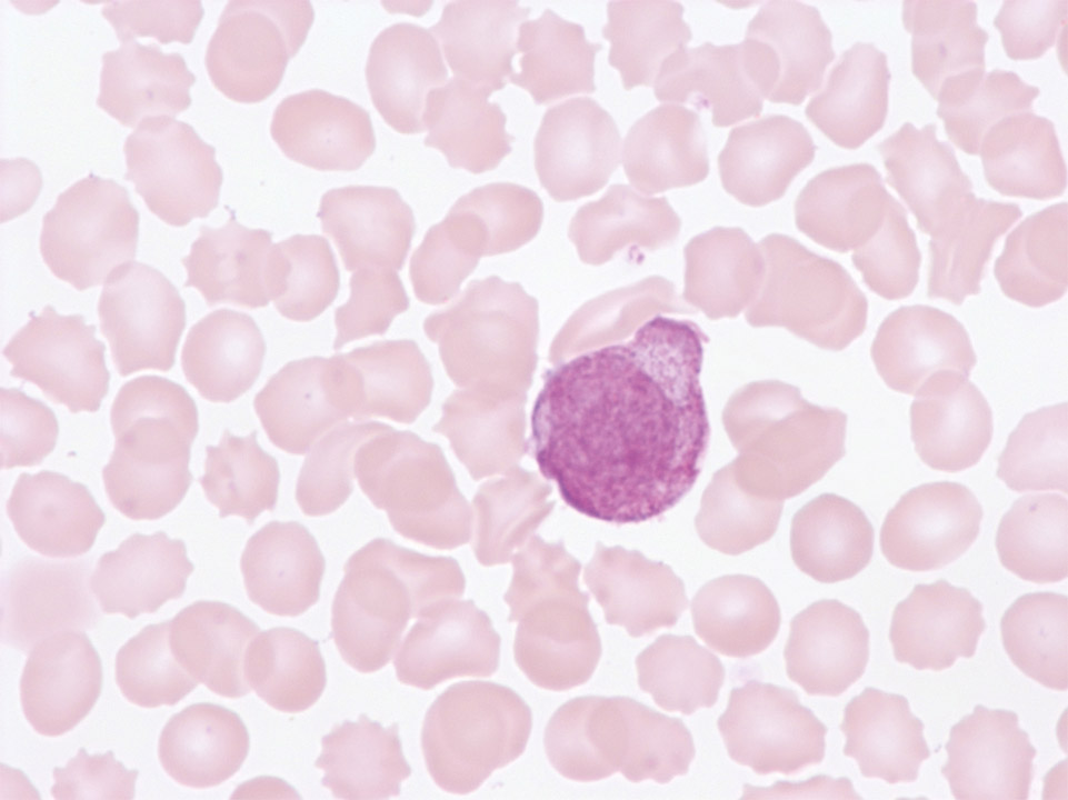 Promyélocyte atypique dans le sang périphérique