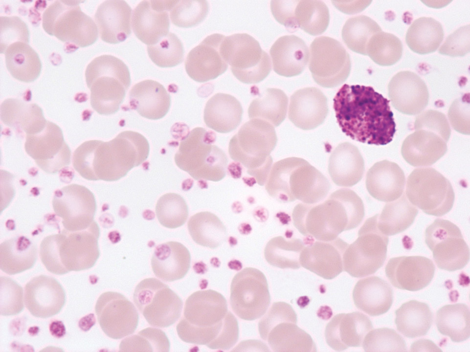 Thrombocytose extrême d’une leucémie myéloïde chronique