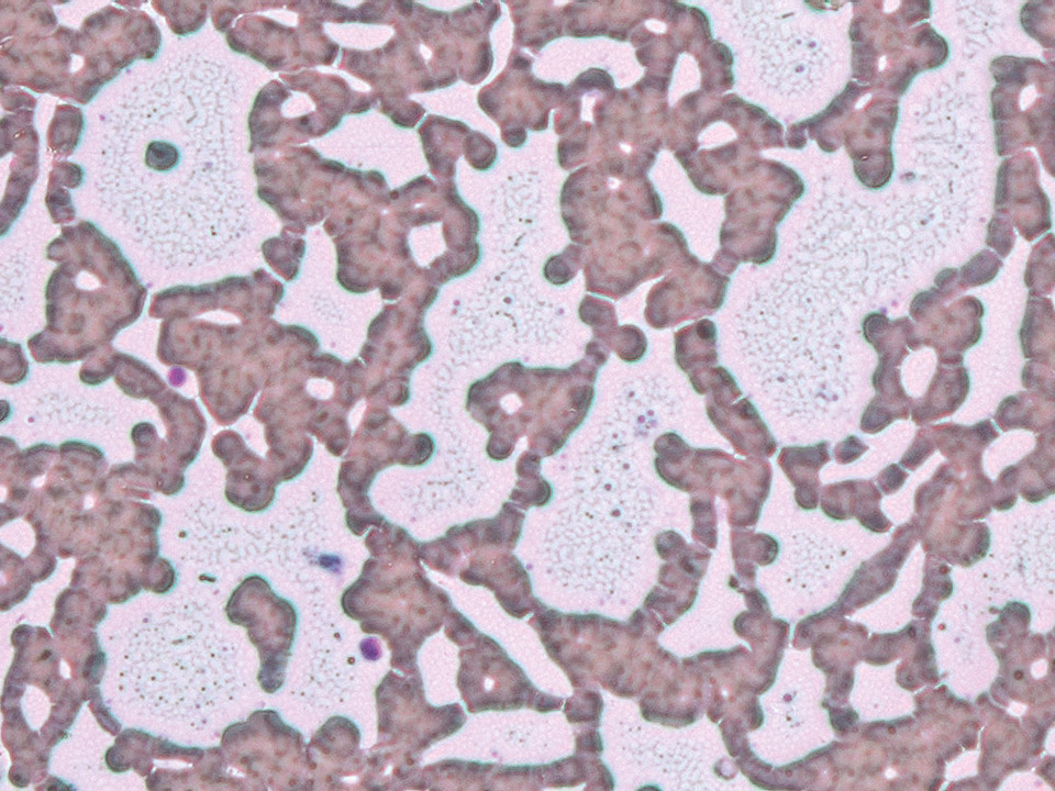 Floculation de cryoglobuline en microscopie à contraste de phase