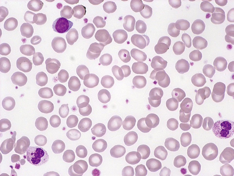 Sang périphérique d'un patient avec thrombocytémie essentielle montrant une thrombocytose isolée