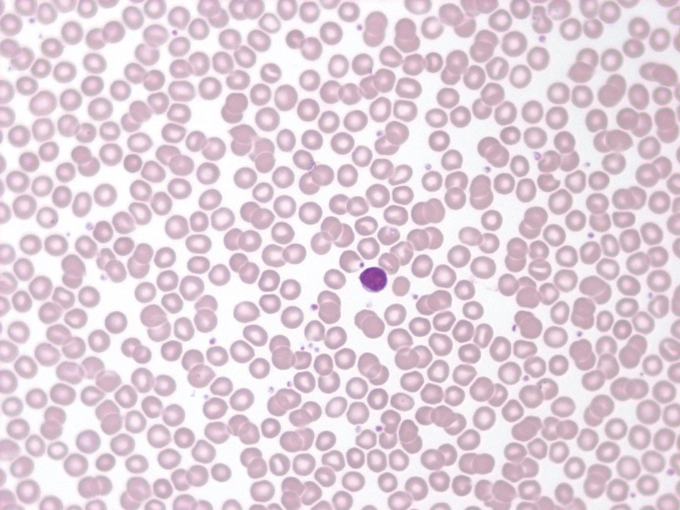 Sang périphérique d'un patient présentant une neutropénie isolée