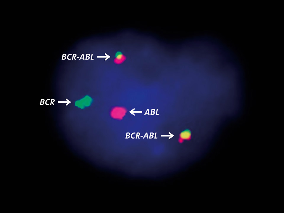 Gène de fusion BCR- ABL détecté par hybridation in situ en fluorescence