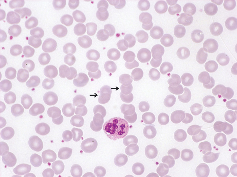 Hématies en rouleaux dans le sang d'un patient avec une polyarthrite chronique