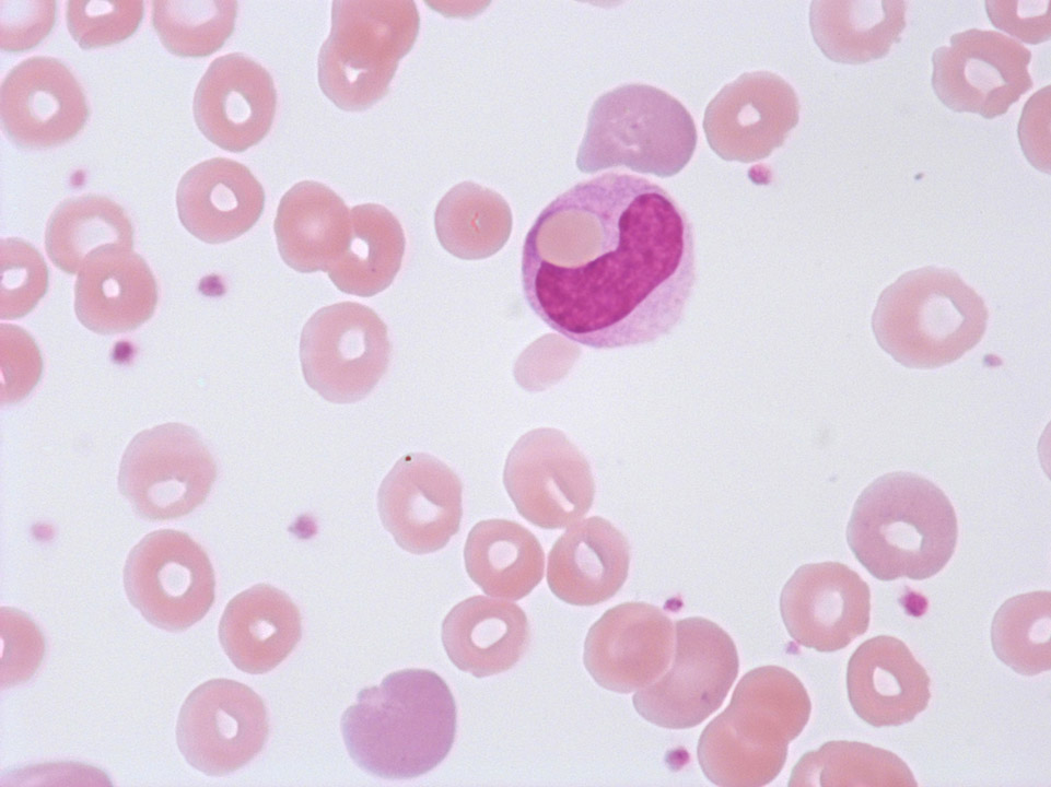 Anémie hémolytique auto-immune ( AHAI ) Anémie hémolytique auto-immune ( AHAI )