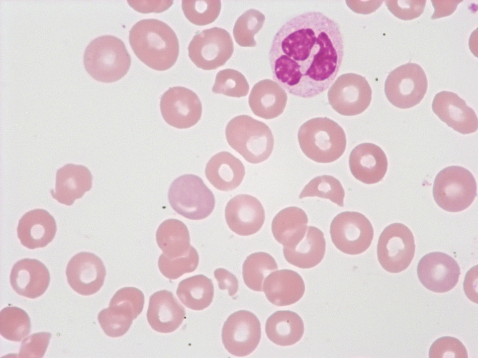 Globules rouges fragmentés et thrombopénie Globules rouges fragmentés et thrombopénie