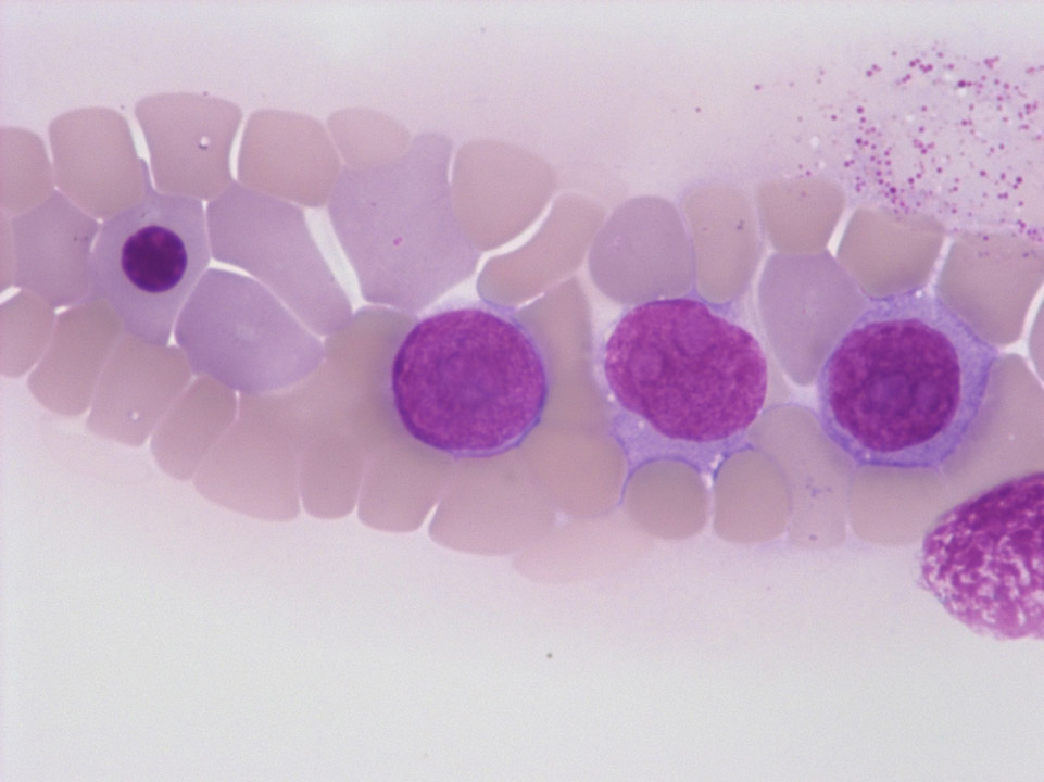 Cellules de carcinome du sein sur frottis sanguin Cellules de carcinome du sein sur frottis sanguin