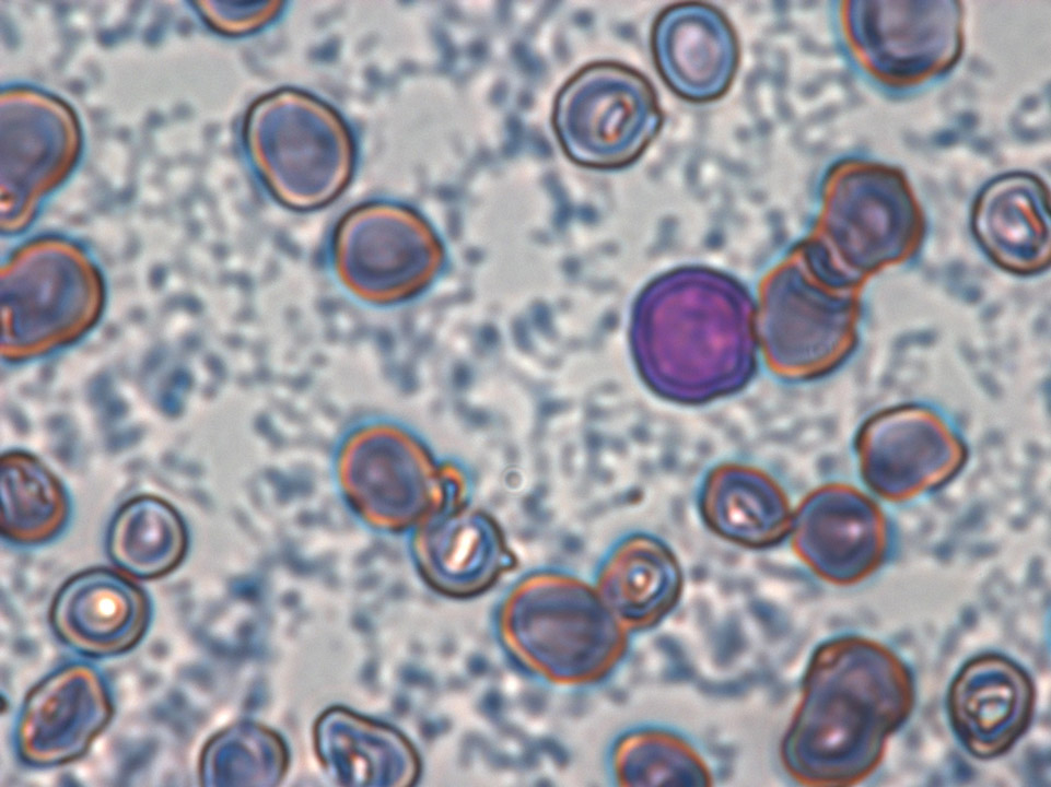 Cryoglobulines floculées Cryoglobulines floculées