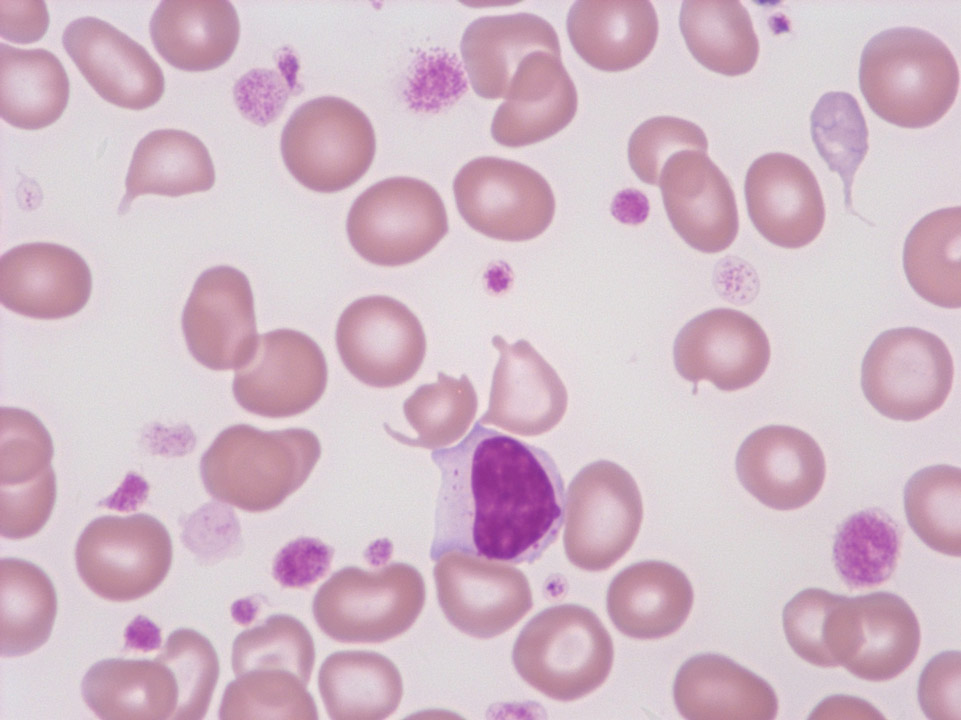 Thrombocytose, anisocytose plaquettaire et plaquettes géantes Thrombocytose, anisocytose plaquettaire et plaquettes géantes
