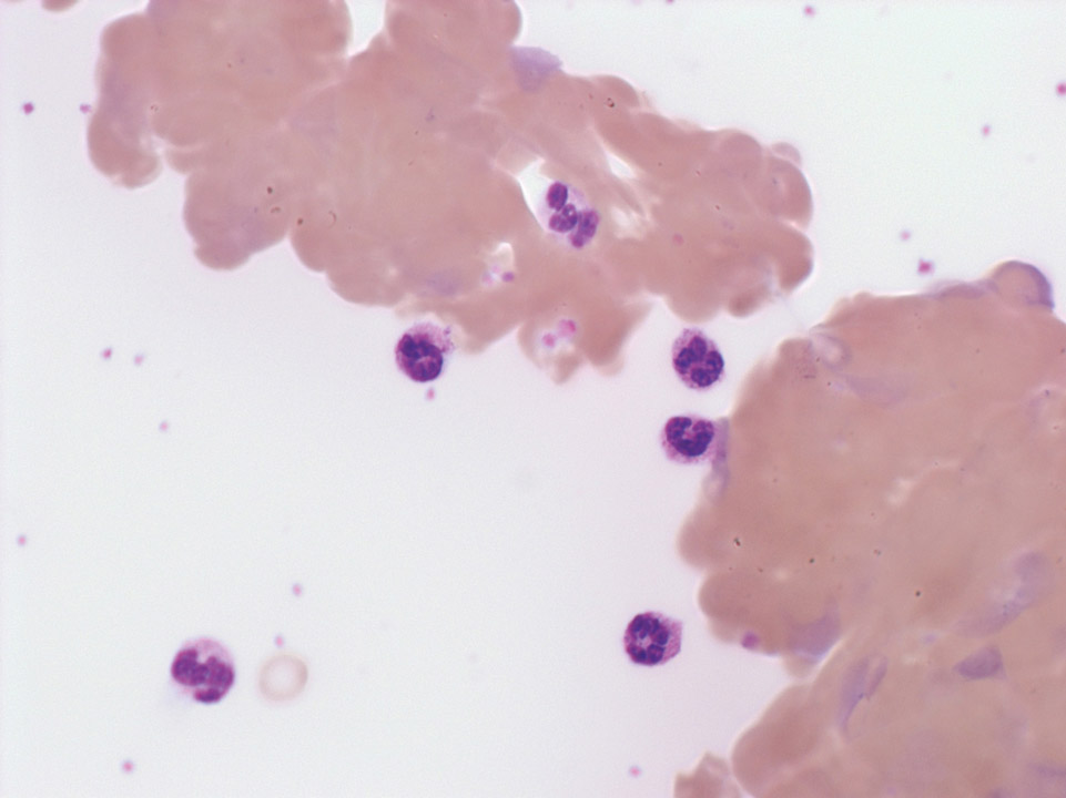 Globules rouges agglutinés et polychromasie marquée Globules rouges agglutinés et polychromasie marquée