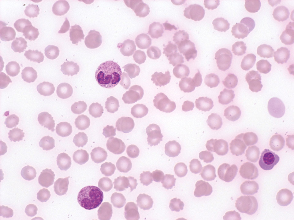 Erythroblastémie et schizocytes Erythroblastémie et schizocytes