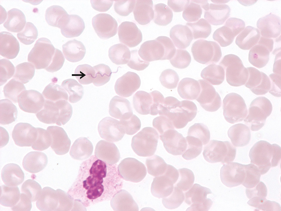 Détection fortuite de Borrelia recurrentis Détection fortuite de Borrelia recurrentis