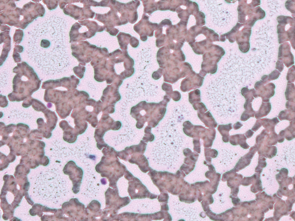 Floculation de cryoglobuline en microscopie à contraste de phase Floculation de cryoglobuline en microscopie à contraste de phase
