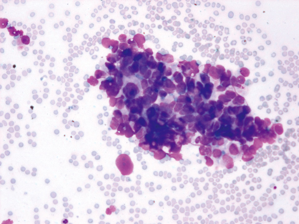 Cytologie de la moelle osseuse montrant de nombreuses cellules tumorales de cancer du sein Cytologie de la moelle osseuse montrant de nombreuses cellules tumorales de cancer du sein