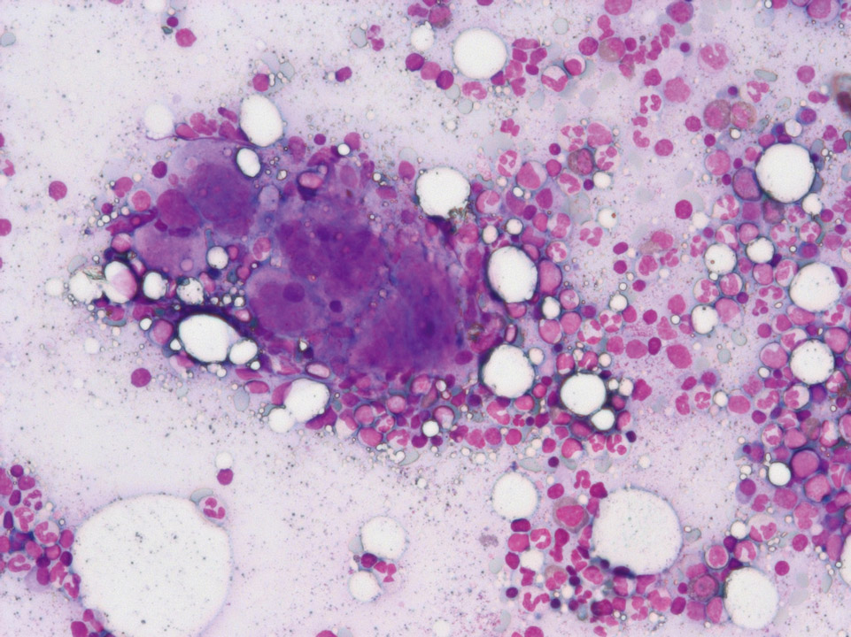 Exceptionnellement grands mégacaryocytes Exceptionnellement grands mégacaryocytes