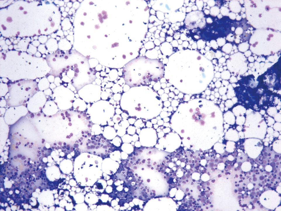 Cytologie de la moelle osseuse d'un patient souffrant d'anémie aplasique Cytologie de la moelle osseuse d'un patient souffrant d'anémie aplasique