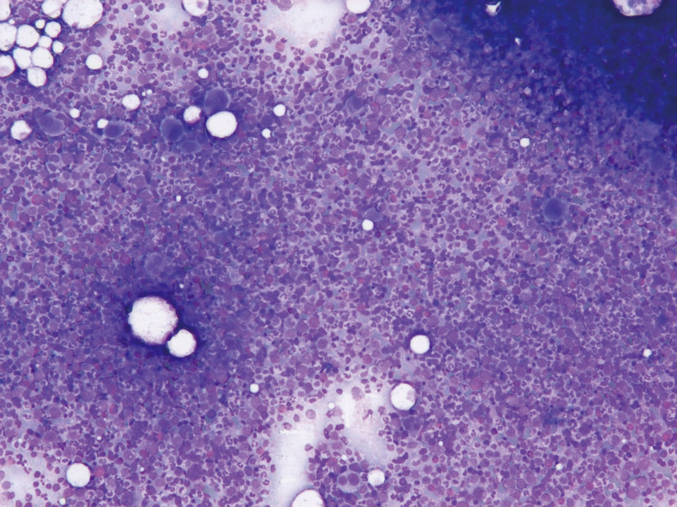 Cytologie de la moelle osseuse d'un patient LMC Cytologie de la moelle osseuse d'un patient LMC