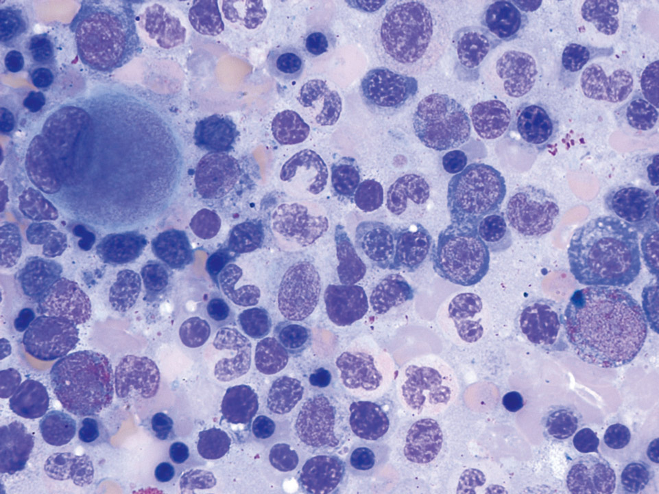 Cytologie de la moelle osseuse montrant les changements dysplasiques dans toutes les lignées cellulaires Cytologie de la moelle osseuse montrant les changements dysplasiques dans toutes les lignées cellulaires