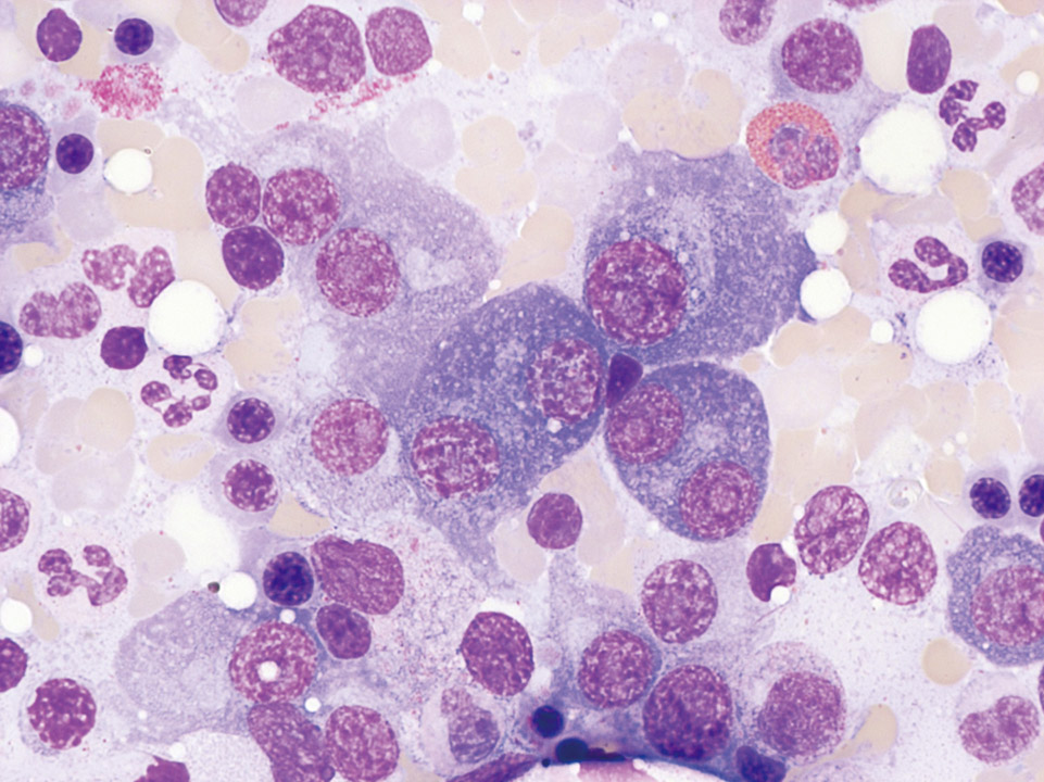 Cytologie de la moelle osseuse d'un patient avec myélome multiple Cytologie de la moelle osseuse d'un patient avec myélome multiple