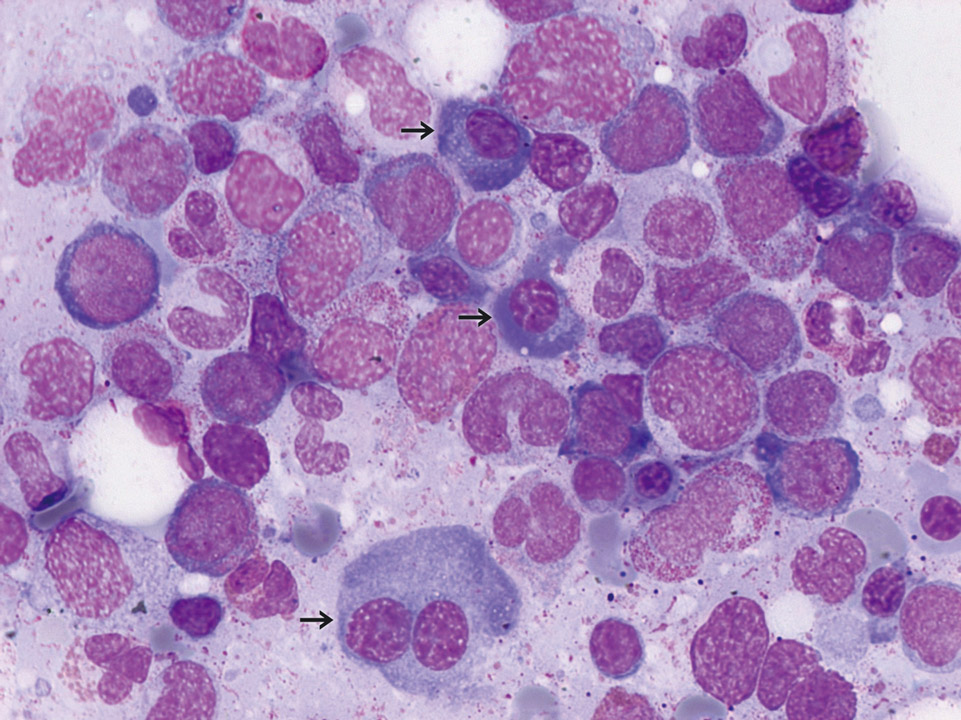 Cytologie de la moelle osseuse d'un patient avec LMMC Cytologie de la moelle osseuse d'un patient avec LMMC