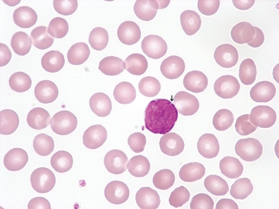 Cellules de lymphome dans le sang périphérique Cellules de lymphome dans le sang périphérique