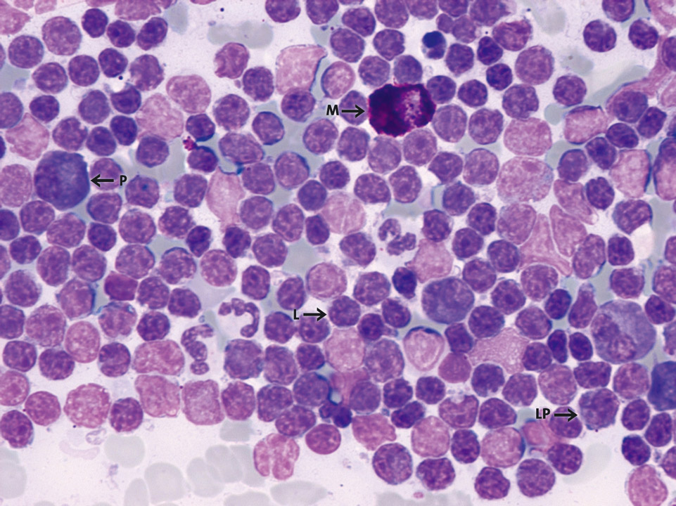 Cytologie de la moelle osseuse d'un patient avec immunocytome Cytologie de la moelle osseuse d'un patient avec immunocytome